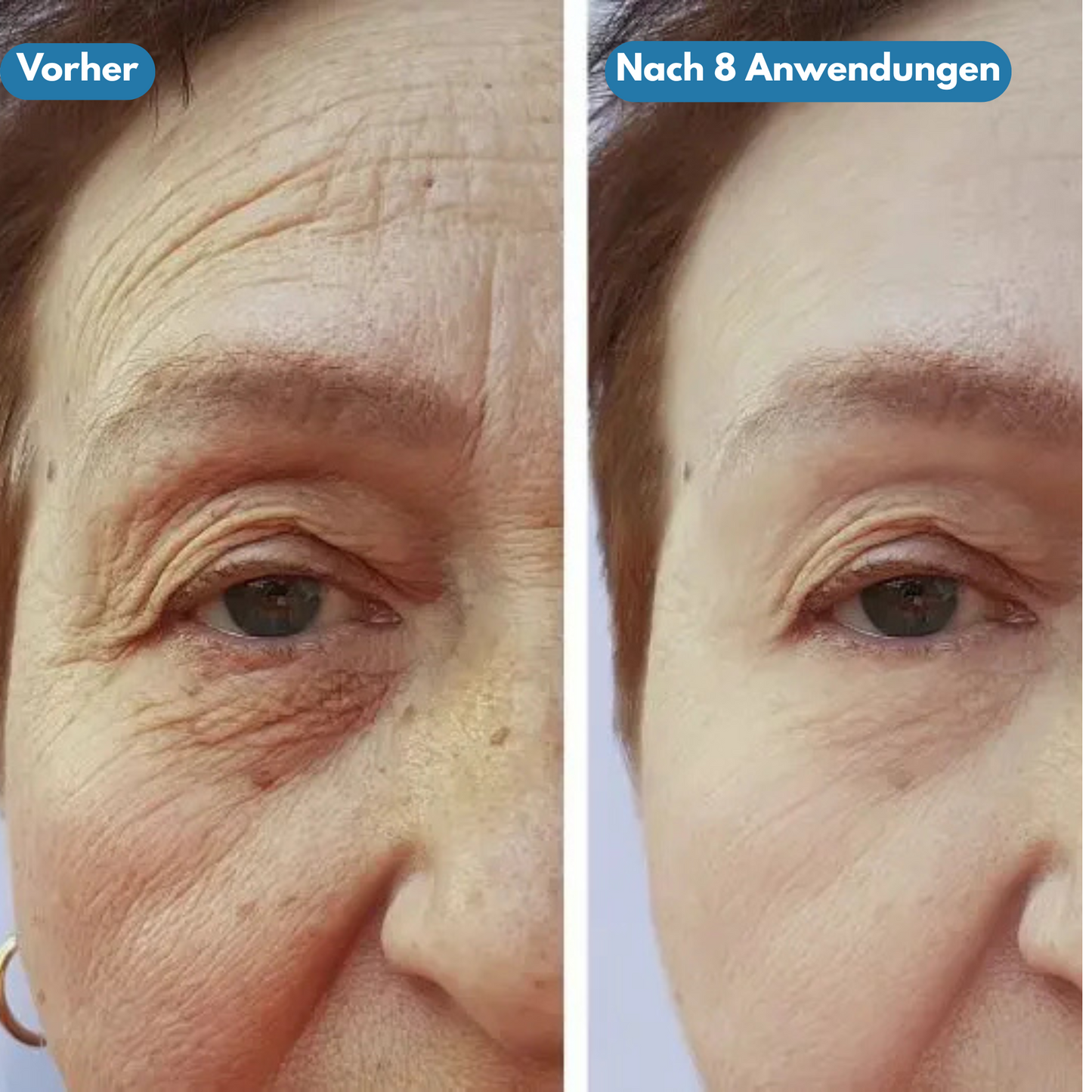 Pureface - Micro Needling Set