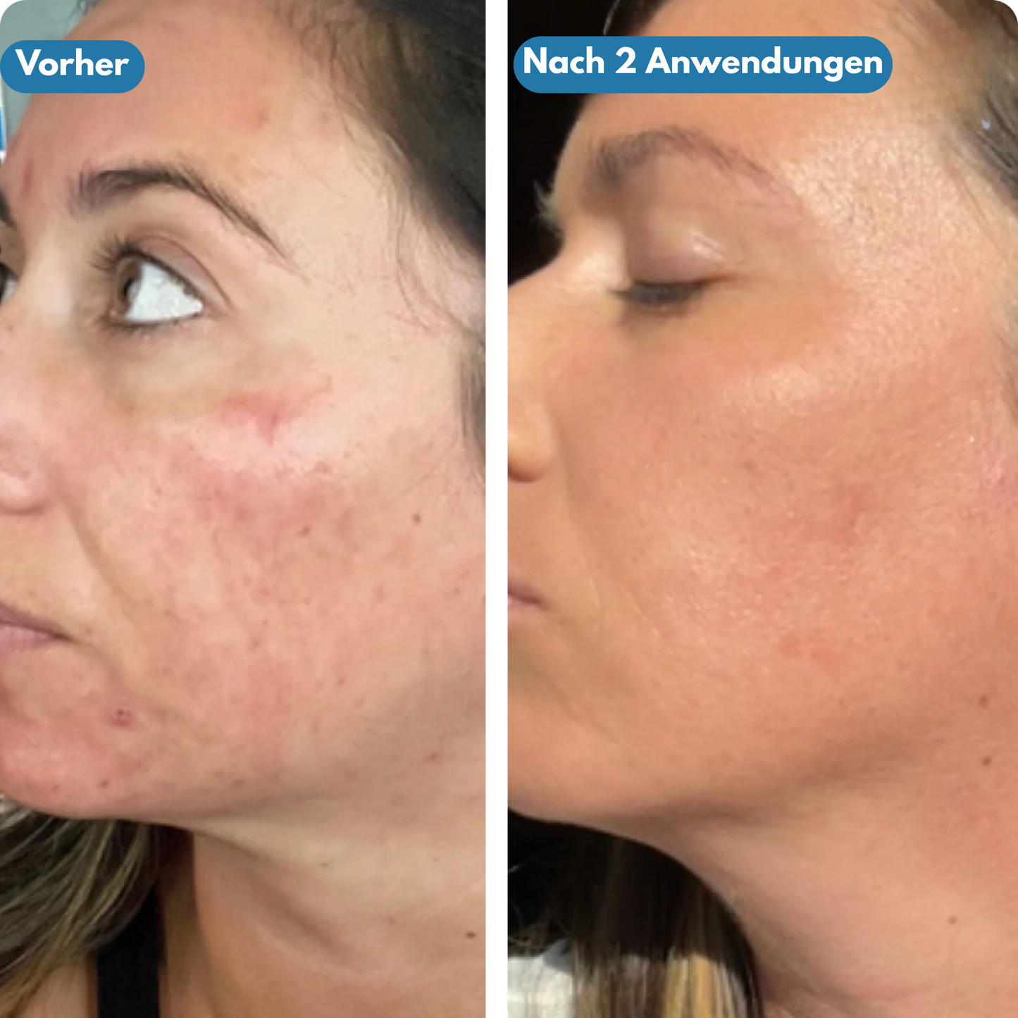 Pureface - Micro Needling Set