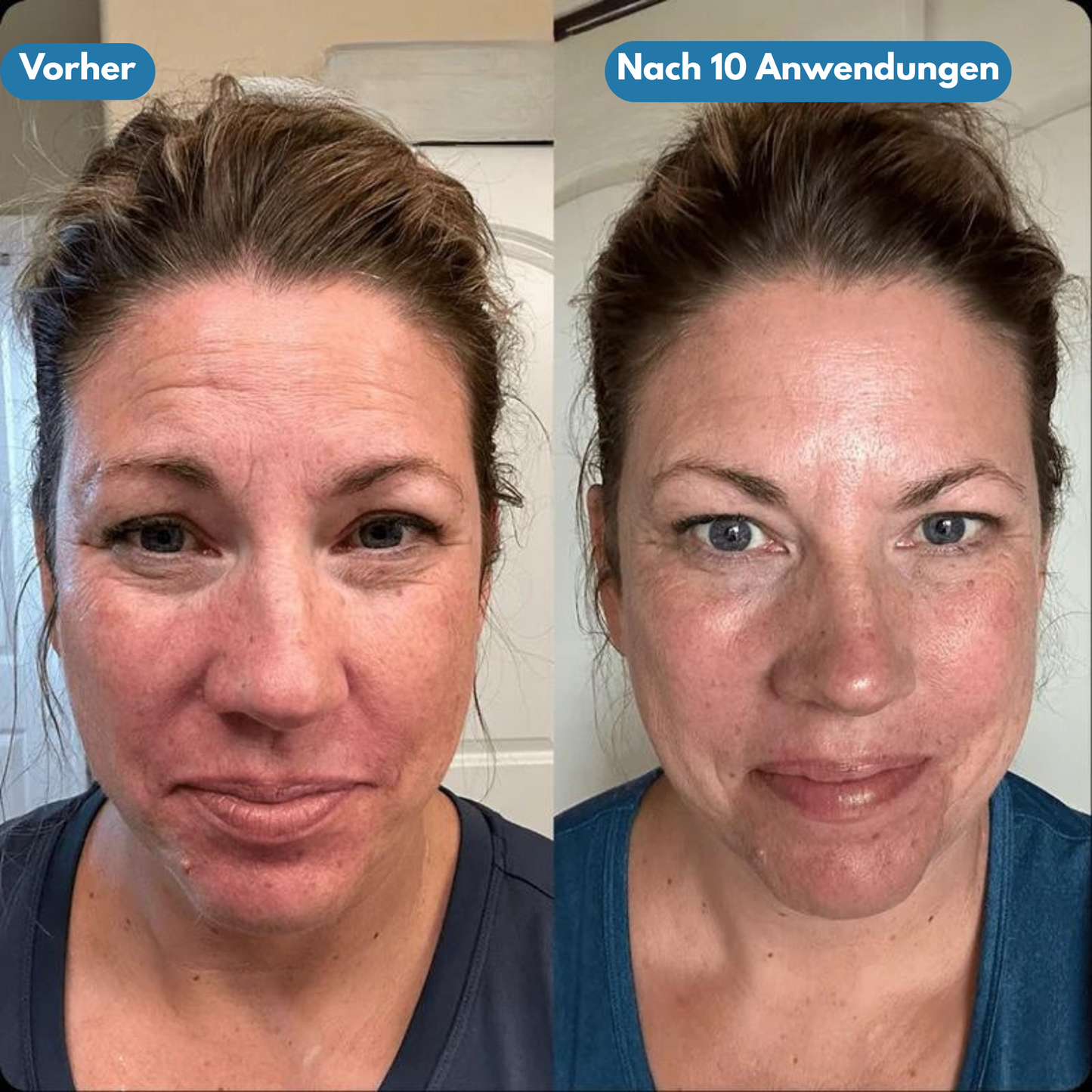Pureface - Micro Needling Set