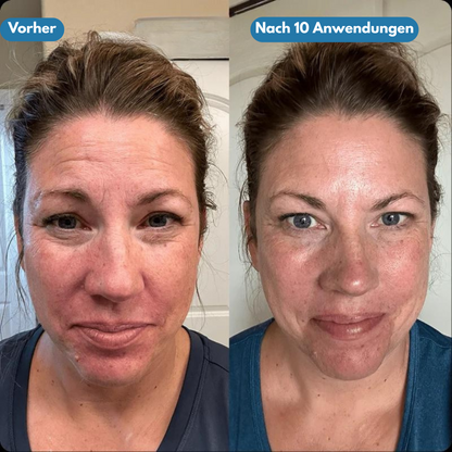 Pureface - Micro Needling Set
