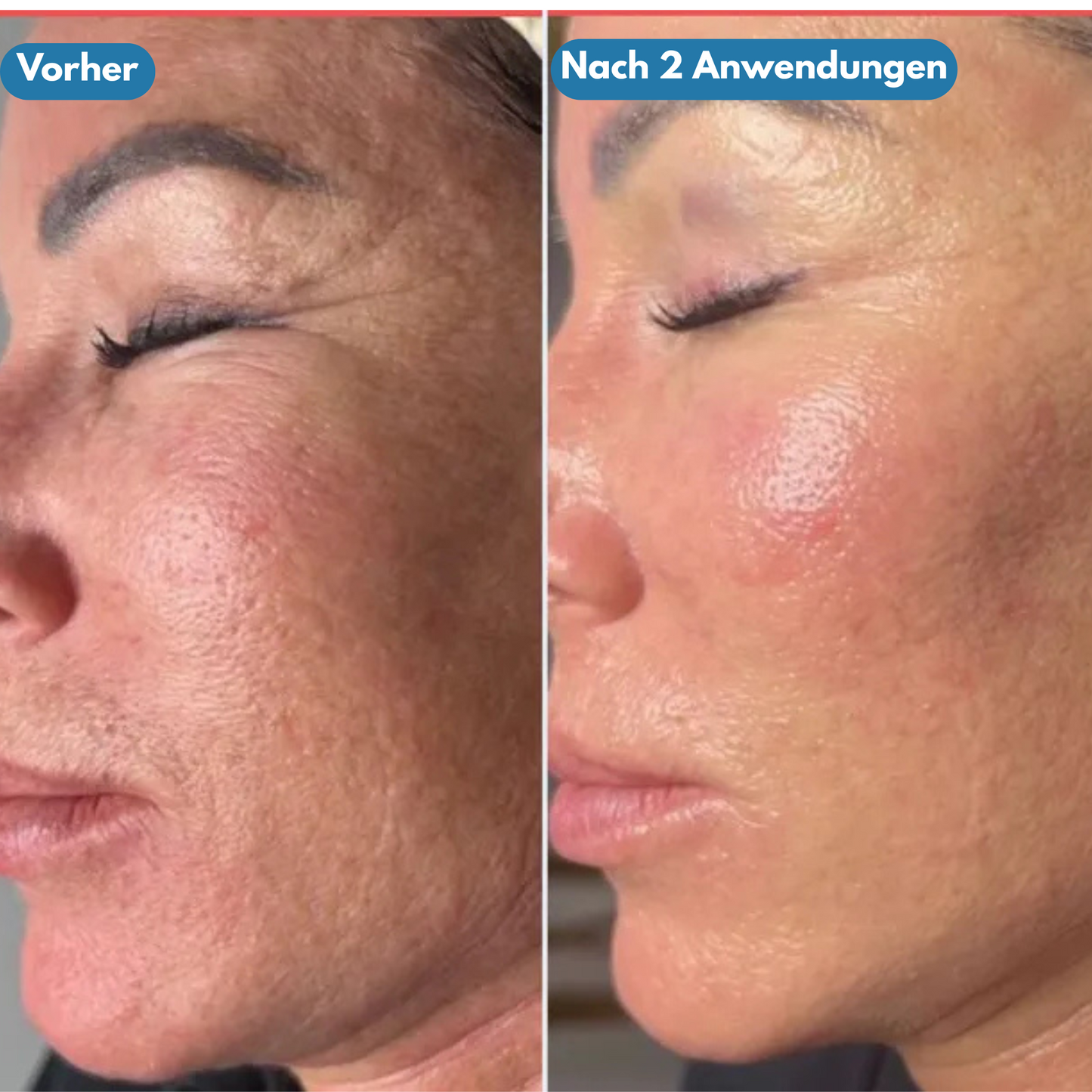 Pureface - Micro Needling Set